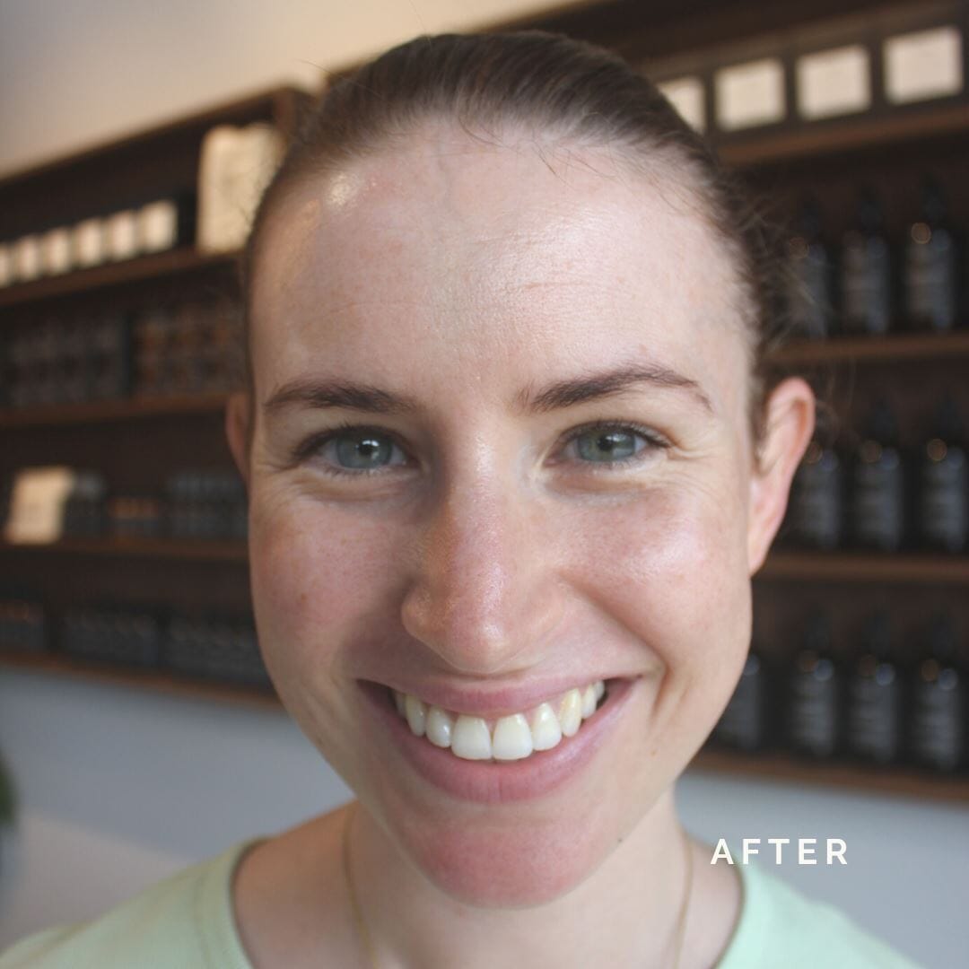 Renew Serum Results | Before and After Series #2