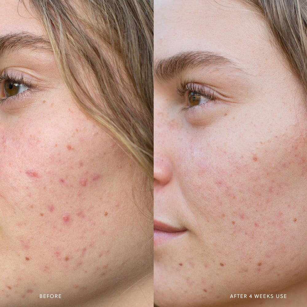 
                      
                        AHA Micro Exfoliator Saya® 
                      
                    