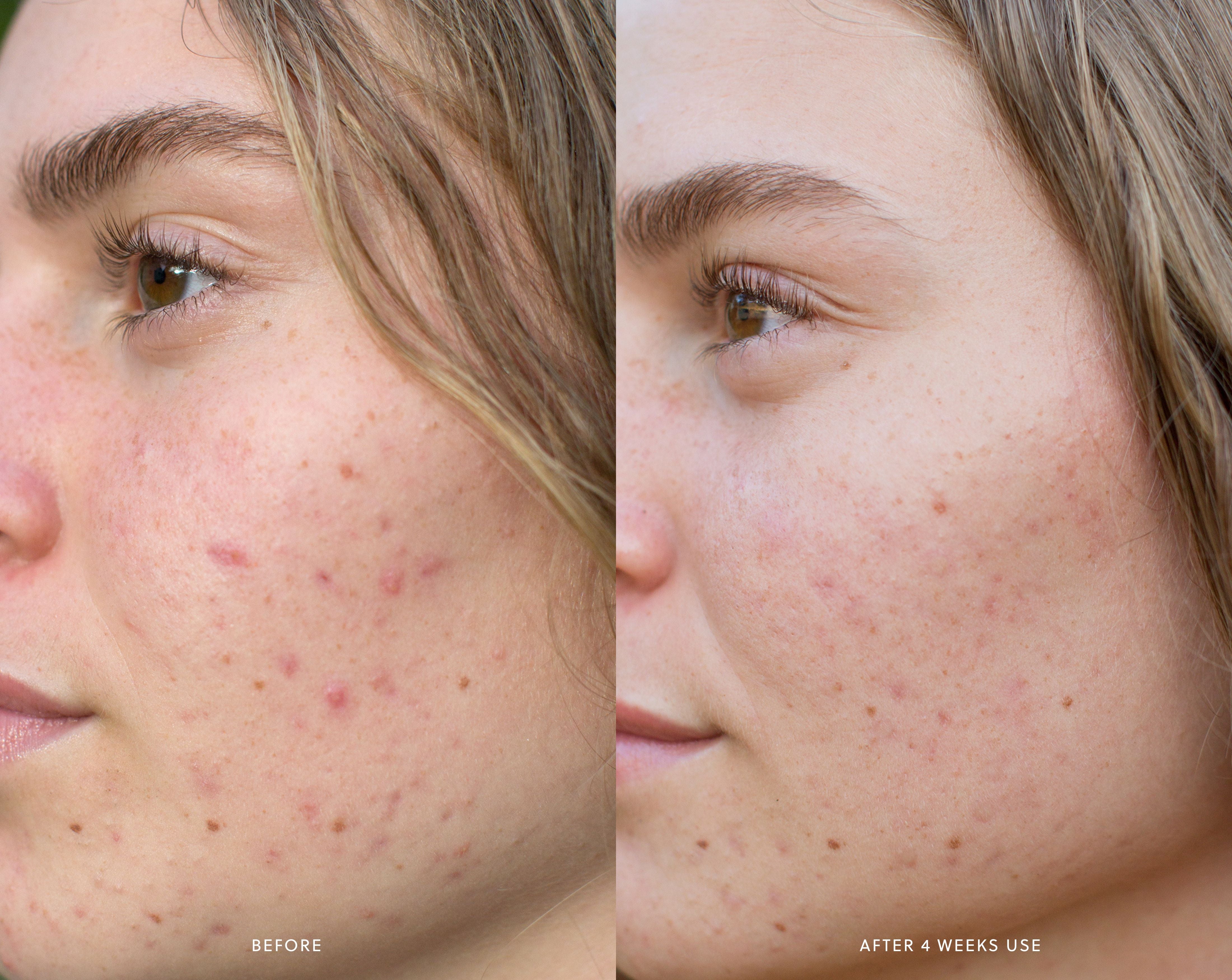 AHA Micro Exfoliator Saya® 